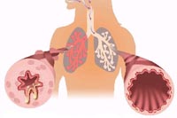 Бронхиальная астма /
Пульмонология /
Диагностика и лечение заболеваний дыхательной системы